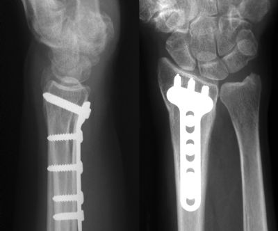 Radius, Distal:  Synthes Angular T-Plate (Implant 293)